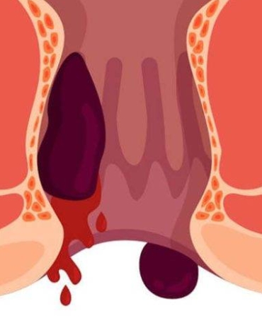 Hemoroid-gorulme-768x731