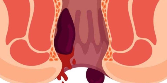 Oturarak Çalışmak hemoroid Sebebi